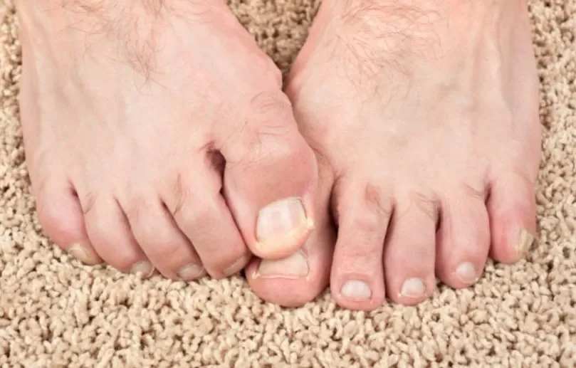 Exofeet oil